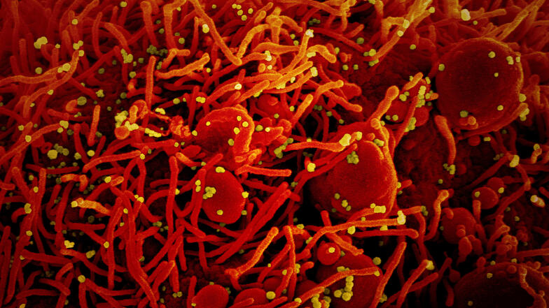 Diese Mikroskopaufnahme zeigt eine Zelle (rot), die mit dem Coronavirus (SARS-CoV-2, gelb) infiziert ist. Die Probe wurde von einem Patienten in den USA isoliert.