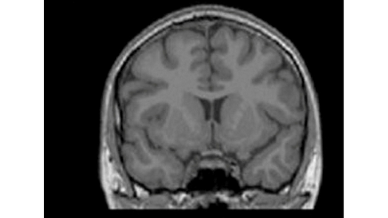 Auf diesem Scan ist das Gehirn der gleichen Patientin nach der Therapie zu sehen. Die graue Masse wirkt praller, die schwarzen Stellen kleiner.