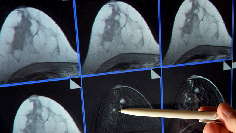 Auf der Bildschirmdarstellung einer Magnetresonanz-Mammographie ist ein winziger Tumor in der Brust einer Patientin zu sehen.