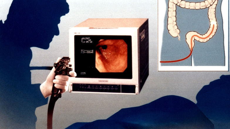 Früherkennung von Darmkrebs - bei einem Videoendoskop erhält der Arzt eine originalgetreue Wiedergabe des untersuchten Organs.