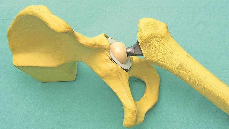 Modell eines künstlichen Hüftgelenkes (Bildmitte). Zwischen dem Beckenknochen (links) und dem Oberschenkelknochen (rechts) sorgt es für die Beweglichkeit. Archivfoto: Jörg Schubert