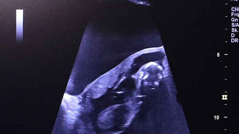 Herz, Niere und Kopf: Das Baby ist so groß, dass auf dem Ultraschallbild nur ein Teil des Tieres zu sehen ist. Auf einem Ultraschallbild vom 5. September war der Nachwuchs noch im Ganzen drauf.