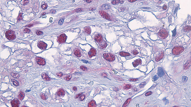 Mikroskopischer Blick ins Tumorgewebe des schwarzen Hautkrebses: Das Enzym Caspase 8, die dunkelroten Punkte, reichert sich in den Zellkernen an und aktiviert den für Patienten fatalen Überlebensmechanismus der Zelle.