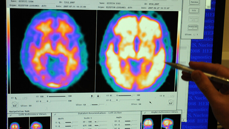 Links das Gehirn eines gesunden und rechts eines Alzheimerpatienten. Die Kombination von Magnetresonanztomographie (MRT) und Positronen-Emissions-Tomographie (PET) ermöglichen eine genauere Diagnostik.