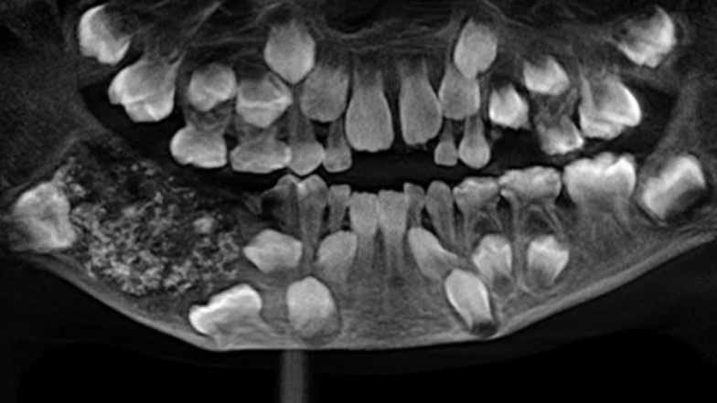 Röntgenbilder zeigen die Zähne des Jungen.