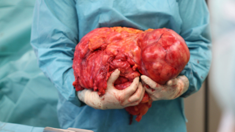 Ein Chirurg des Klinikums Altenburger Land hält einen 15 Kilogramm schweren Tumor, der unbemerkt im Bauchraum einer 63-Jährigen gewachsen ist, in der Hand.