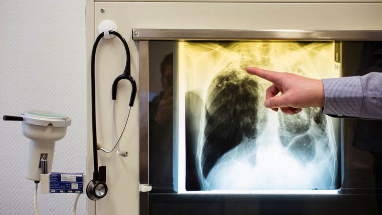 Ein Arzt zeigt einen Tuberkulose-Fall anhand eines Röntgenbildes. In Chemnitz ist die Krankheit zum zweiten Mal in diesem Jahr ausgebrochen.