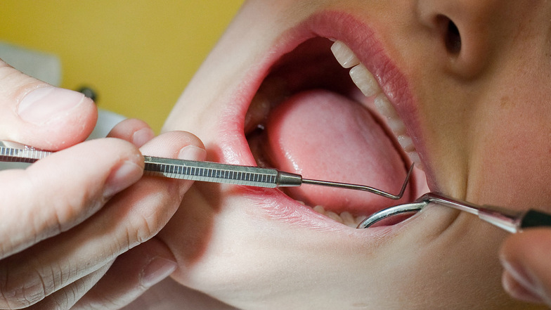 Ein Drittel der Zwölfjährigen in Deutschland hat Karies in den bleibenden Zähnen.