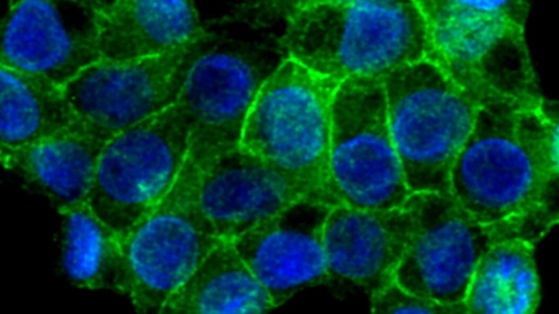 Das Protein PD-L1, hier grün eingefärbt, auf der Oberfläche von Darmkrebszellen. Das Eiweiß bremst wichtige Immunzellen aus und wird von vielen Krebszellen vermehrt gebildet.