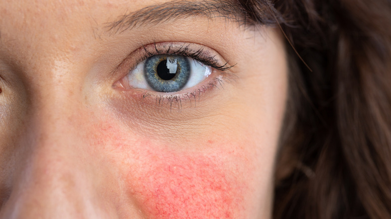 Hautkrankheit Rosacea: Diese Produkte und Behandlungen können helfen