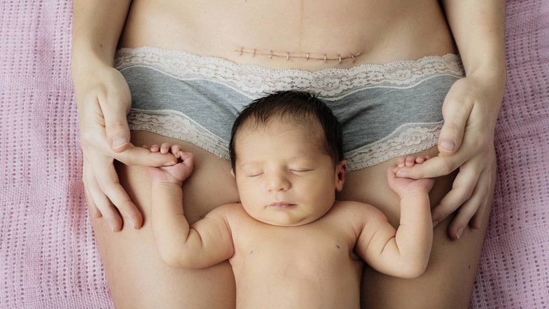 Ein Kaiserschnitt ist ein großer Eingriff. Der Schnitt muss auf drei Ebenen vernäht werden und kann auch Jahre nach der Geburt für Beschwerden sorgen.