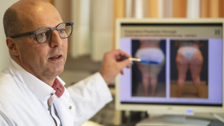 Dr. Jens-Peter Sieber, Chefarzt der Klinik für Plastische und Rekonstruktive Chirurgie am Klinikum Pirna, Bild einer Lipödem-Patientin: „Nach meiner Erfahrung ist eine Fettabsaugung die sinnvollste Therapie.“