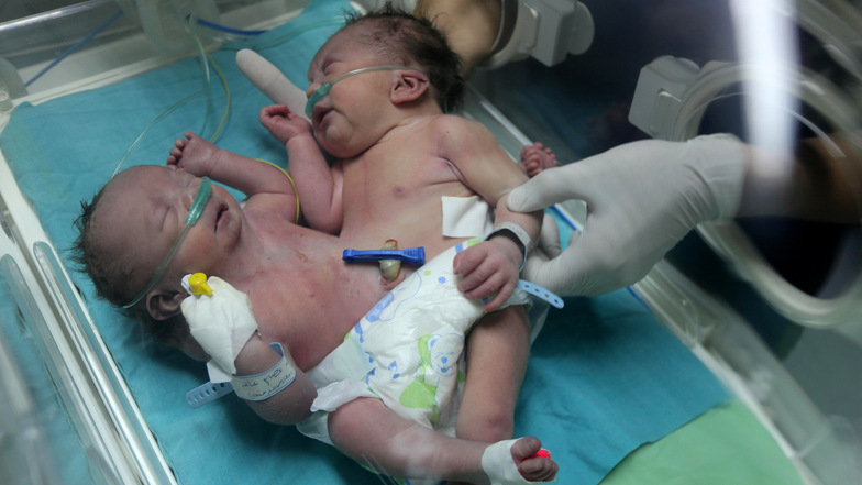 Neugeborene siamesische Zwillinge mit einem Körper und zwei Köpfen liegen im Oktober 2017 auf einer Intensivstation im Shifa Krankenhaus in Gaza. 