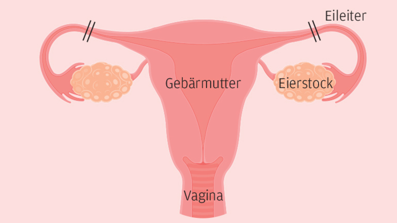 Nach einer Sterilisation können die Eizellen nicht mehr in die Gebärmutter gelangen und befruchtet werden.
