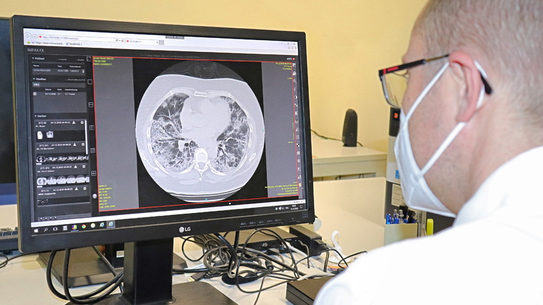 Der Pneumologe Dawid Gocal zeigt am Bildschirm im Malteser Krankenhaus St. Carolus in Görlitz den Querschnitt einer kranken Lunge. Lungenkrankheiten sind ein Schwerpunkt des Carolus-Krankenhauses.