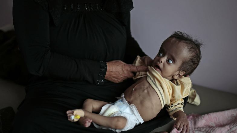 Eine Frau hält ihren unterernährten Jungen im Al Sabeen Krankenhaus im jemen im Arm.