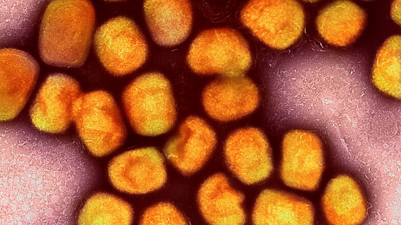 Eine kolorierte Aufnahme von Partikeln des Affenpockenvirus. Der Erreger breitet sich erneut in Europa aus