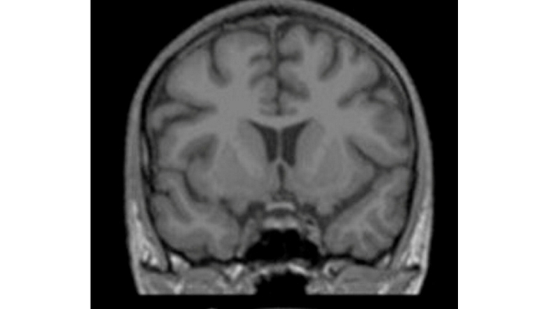 Der Gehirnscan zeigt das Gehirn einer magersüchtigen Patientin des Uniklinikums Dresden vor der Therapie.
