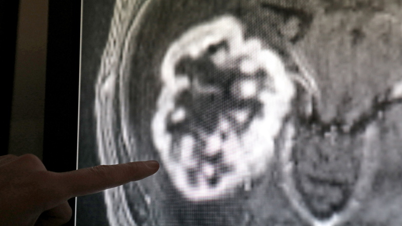 Mit Hilfe der Magnetresonanztomographie wird ein Tumor festgestellt.