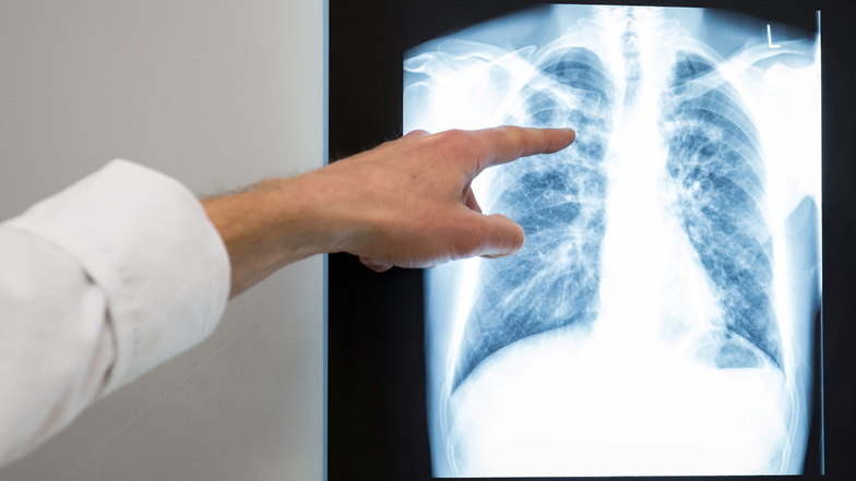 Ein Arzt zeigt auf das Röntgenbild einer Lunge.