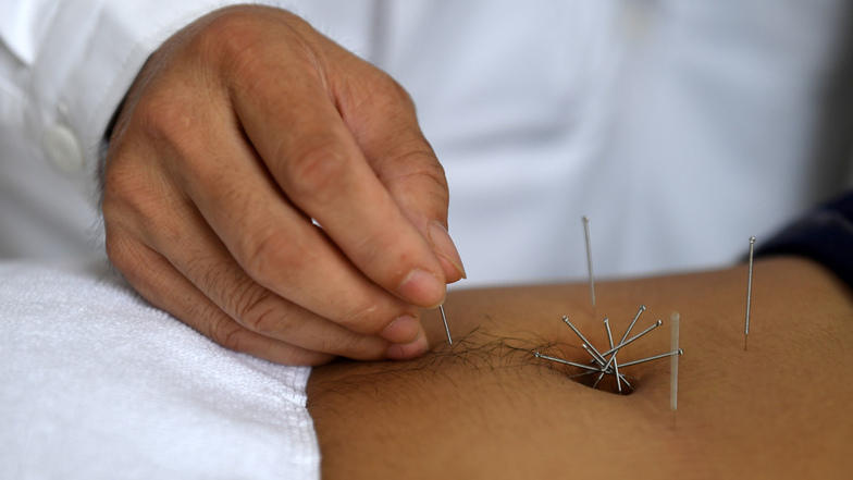 Akupunktur gehört zu den alternativen Medizinen, die die WHO nun in Indien genauer erforschen will.