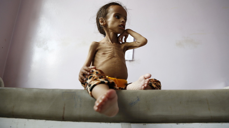 Ein unterernährtes vierjähriges Mädchen sitzt auf einem Bett in einem Krankenhaus in Sanaa im Jemen. Der Ukraine-Krieg hat die Ernährungs-Situation vieler Menschen verschlimmert