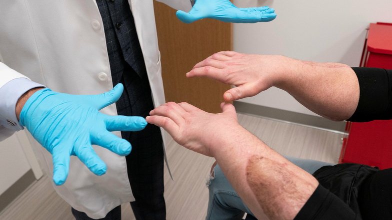 Ein Operationsteam amputierte beide Hände von DiMeo, ersetzte sie in der Mitte des Unterarms und verband Nerven, Blutgefäße und 21 Sehnen mit haardünnen Nähten. Die Narbe auf DiMeo's Unterarm zeigt, wo die neue Hand angebracht wurde.