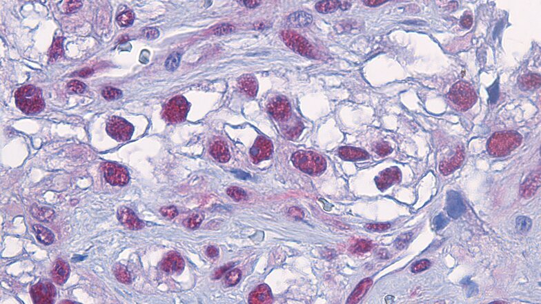 Blick in Tumorgewebe des malignen Melanoms: Das Enzym Caspase 8 (dunkelrote Punkte) reichert sich in den Zellkernen an und aktiviert den für Patienten fatalen Überlebensmechanismus der Zelle.