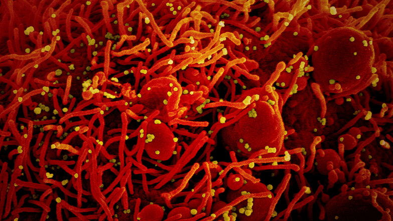 Eine Zelle (rot) ist mit dem Coronavirus (SARS-CoV-2, gelb) infiziert.