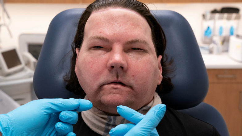 Joe DiMeo wird im Medizinischen Zentrum NYU Langone untersucht. Vor sechs Monaten wurden bei ihm Transplantationen des Gesichts und an beiden Händen durchgeführt. Während der Untersuchung übte er, seine Augenbrauen anzuheben, die Augen zu öffnen und 