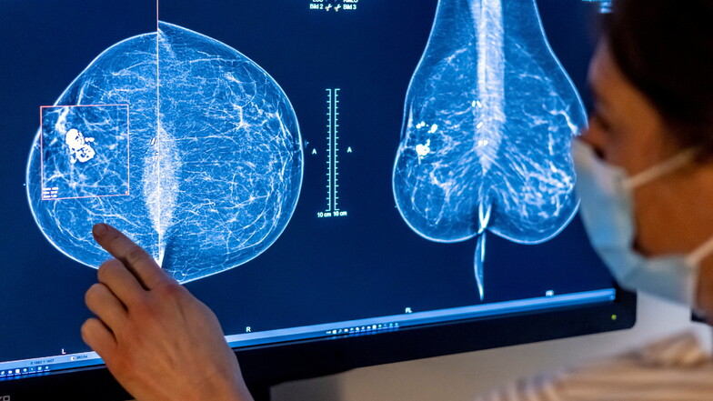 Zeigt das Mammografiebild Brustkrebs? In Deutschland erkrankt eine von acht Frauen im Laufe ihres Lebens daran.