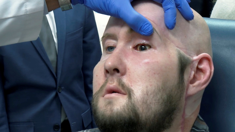 Aaron James hat die erste vollständige Augentransplantation bekommen.