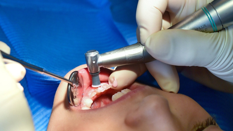Etwa jedes 20. Grundschulkind in Sachsen hat laut dem Zahnreport der Krankenkasse Barmer sogenannte Kreidezähne.