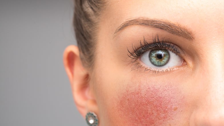 Hautkrankheit Rosacea: Ist die Sonne schuld?