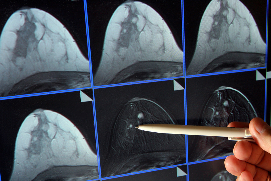 37++ Gutartiger tumor brust bilder , Gute Nachricht für Patientinnen mit Brustkrebs Sächsische.de